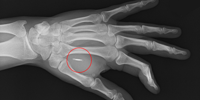 Röntgenbild av hand där man ser ben och microchip